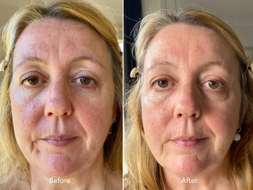 Before and after comparison of a woman's face with visible skin texture differences.