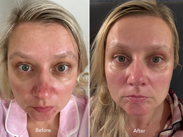 Before and after comparison of a woman's face with visible skin improvement.