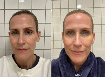 Before and after comparison of a woman with visible skin improvement.