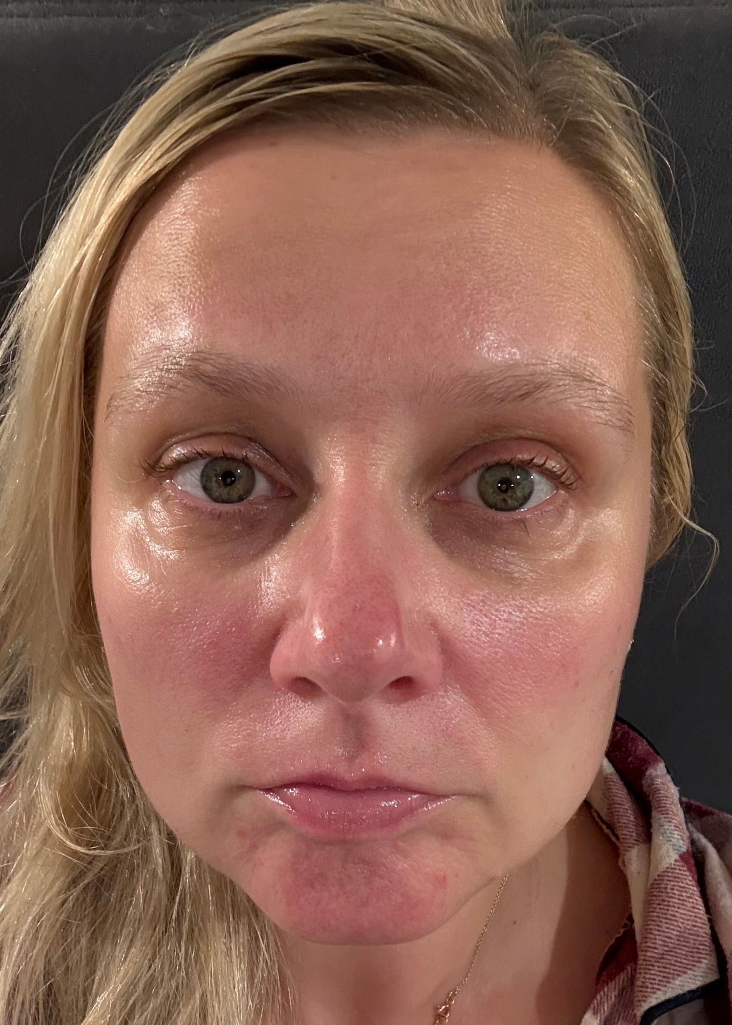 Close up of a middle aged woman's face looking into the camera as a 'after shot' showing calmer skin, reduced pigmentation and no spots on her face and nose.