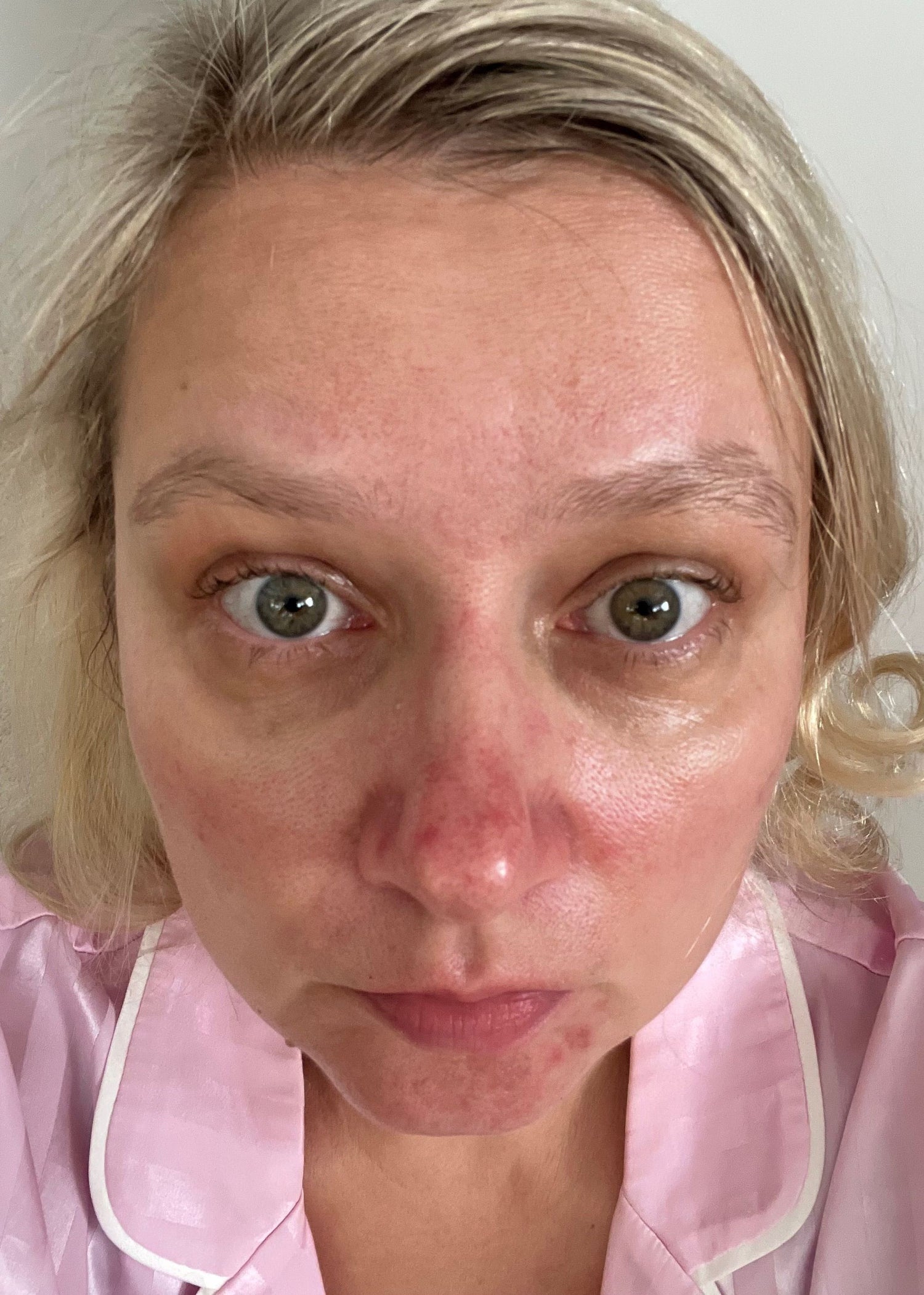 Close up of a middle aged woman's face looking into the camera as a 'before shot' showing irritation, pigmentation and spots on her face and nose.